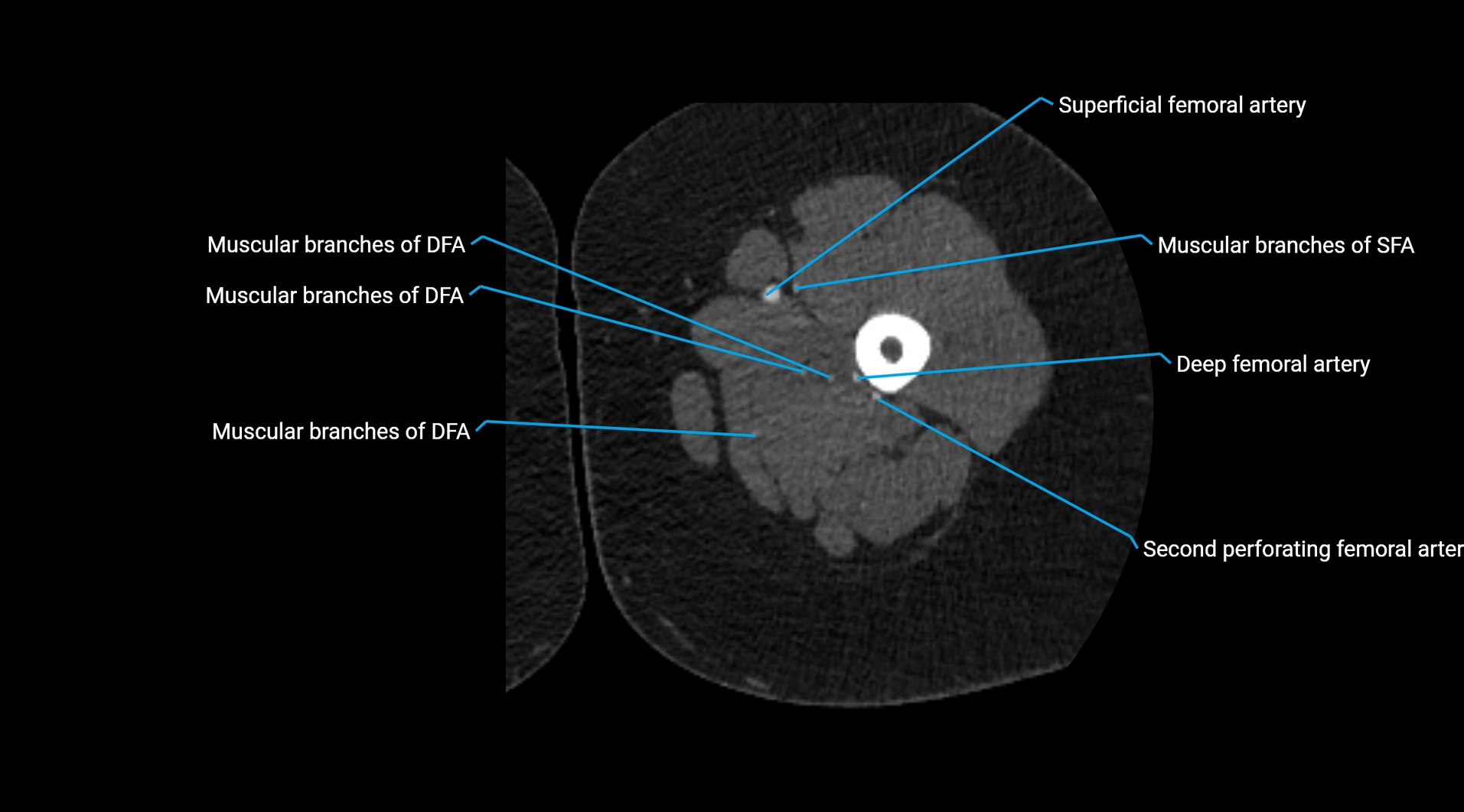 CTA lower limb cross sectional anatomy labelled image _110.webp